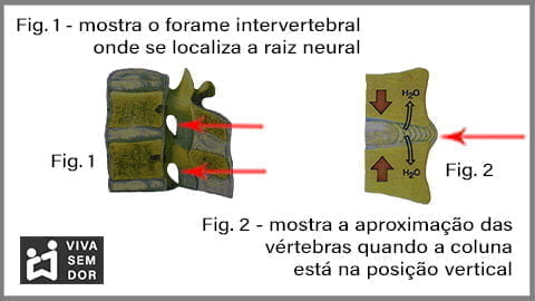 aproximacao-das-vertebras-e-a-dor-no-joelho-vivasemdor