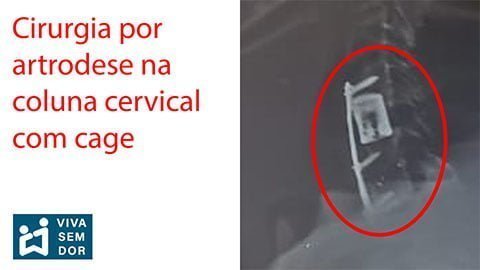 artrodese-com-cage-na-coluna-cervical-vivasemdor