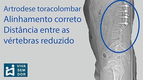 artrodese-toracolombar-com-distancia-entre-as-vertebras-reduzido-vivasemdor