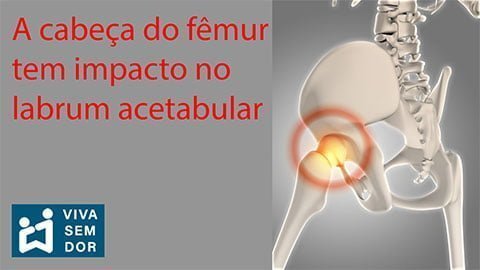 cabeca-do-femur-tem-impacto-com-o-labrum-acetabular-vivasemdor