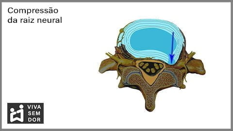 compressao-da-raiz-neural-e-a-dor-no-joelho-vivasemdor