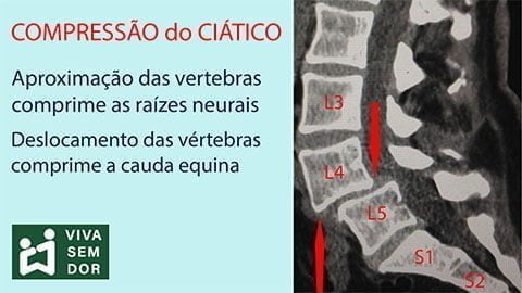 compressao-do-ciático-vivasemdor