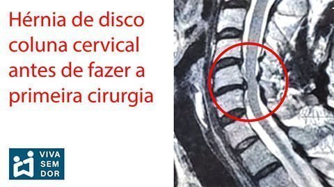 hernia-de-disco-cervical-antes-da-cirurgia-vivasemdor