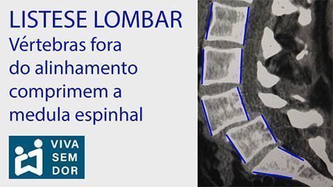 listese-lombar-comprime-a-medula-espinhal-vivasemdor