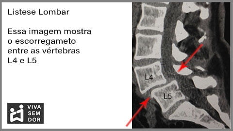 listese-lombar-e-a-dor-no-joelho-vivasemdor