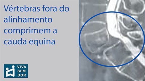 vertebras-fora-do-alinhamento-comprimem-a-cauda-equina-vivasemdor