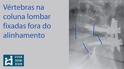 vertebras-na-coluna-lombar-fixadas-fora-do-alinhamento-vivasemdor